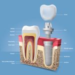 Cement Retained vs Screw Retained – Which Implant Option Is Better?