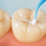 Do Dental Sealants Hurt? Not Really Here’s Why