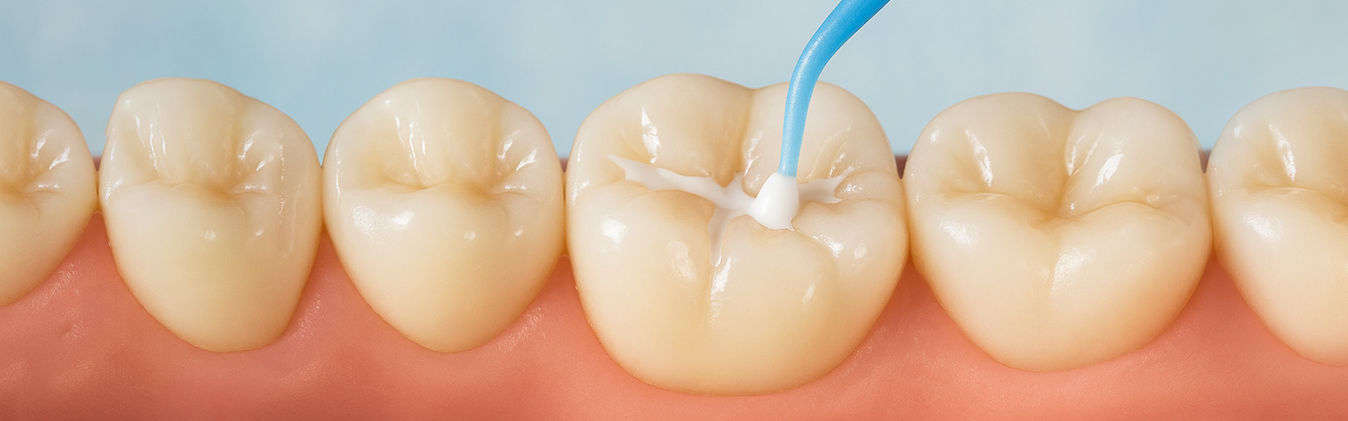 Do Dental Sealants Hurt? Not Really Here’s Why