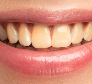 Why Do Teeth Become Stained Again After Whitening?